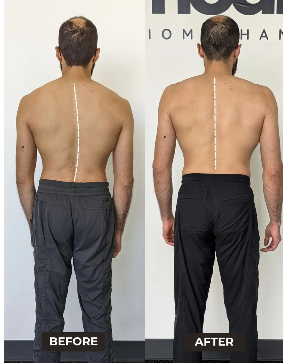 Same client from behind before and after training: a spine curving to one side before, a straight line from neck to waist after